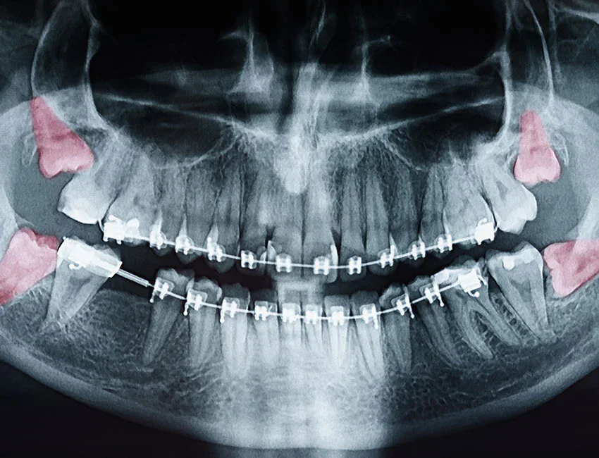 wisdom teeth