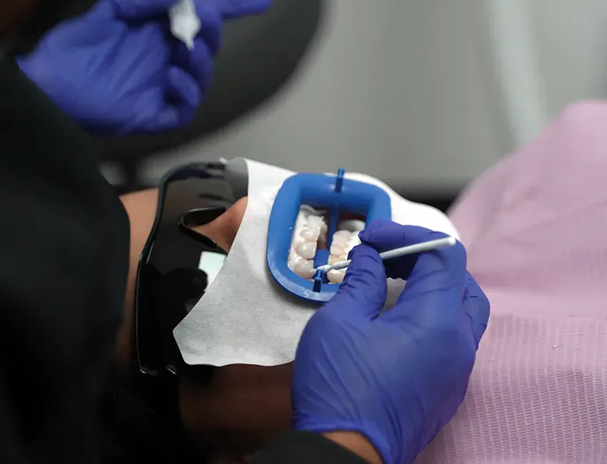 teeth whitening strips in Rancho Santa Margarita