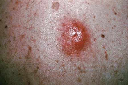 Close-up example showing what melanoma moles look like.