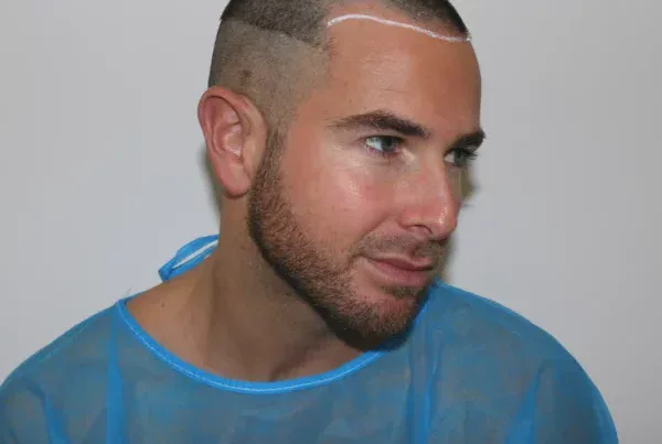 is a hair transplant permanent