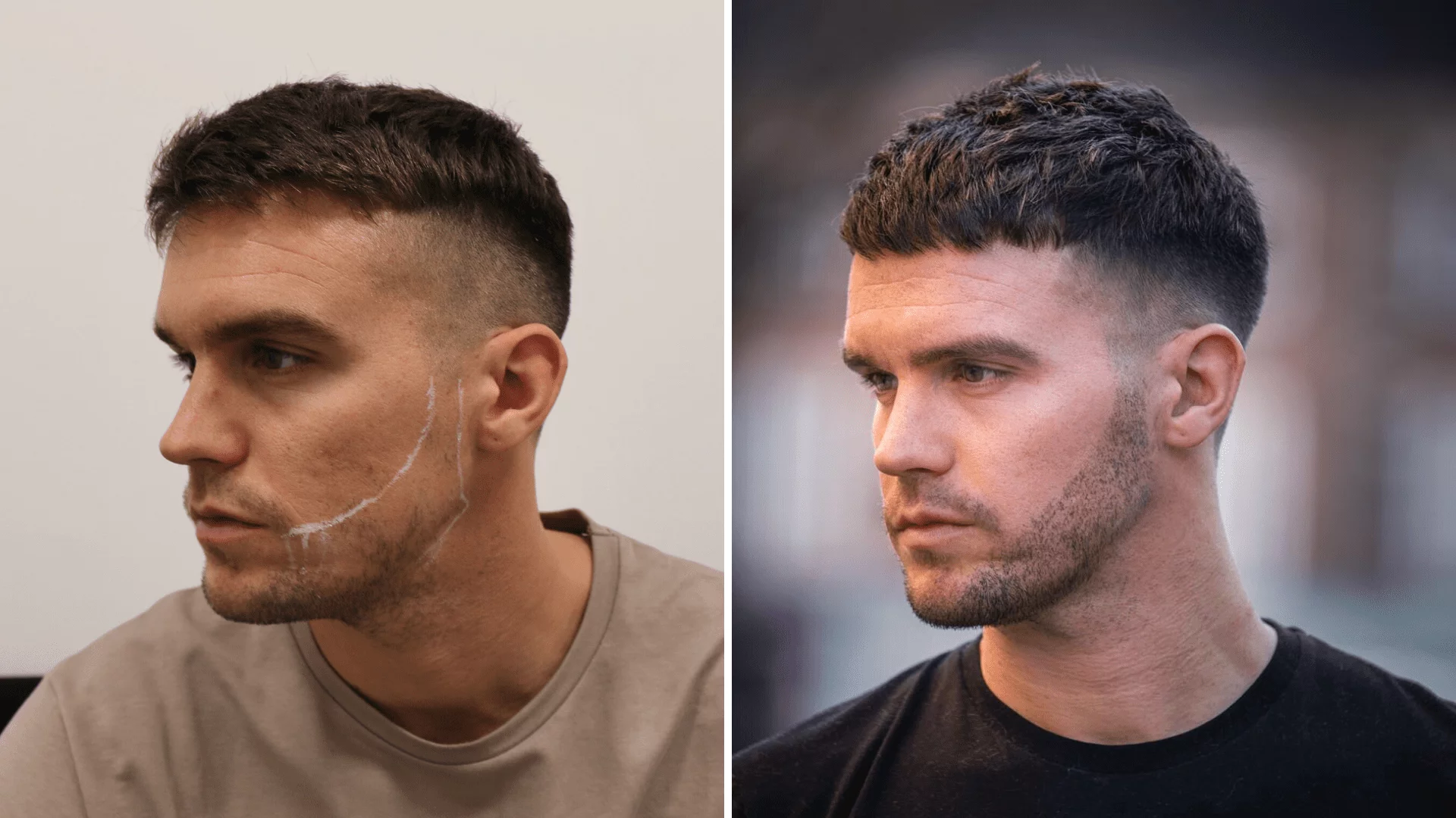 beard transplant before and after
