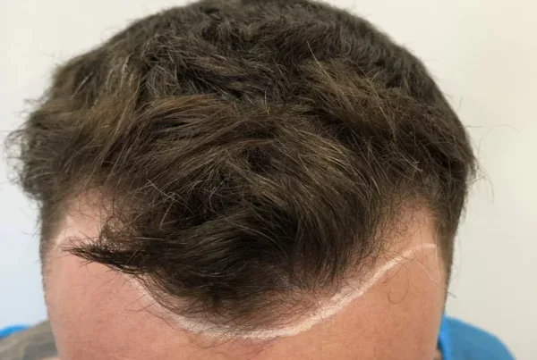 Is My Hairline Receding or Mature?