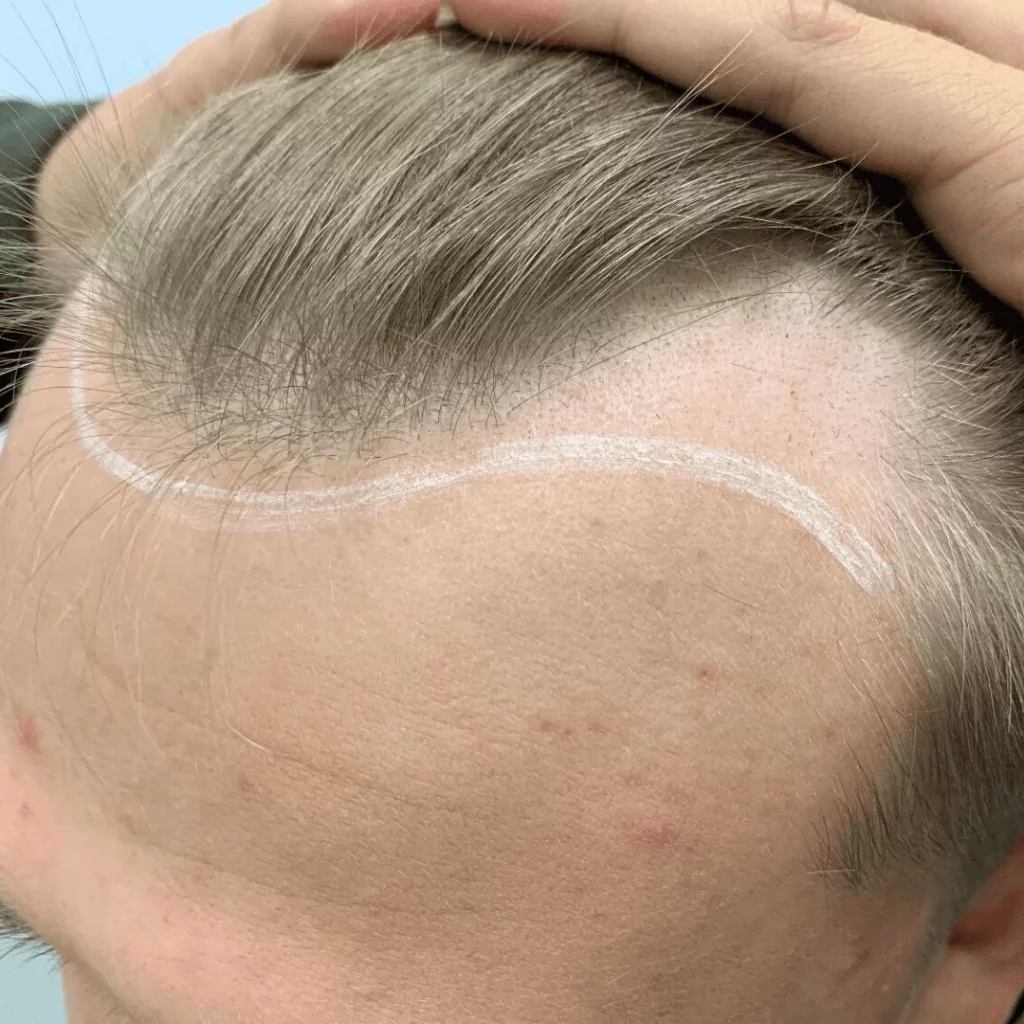 is-there-a-cure-for-balding