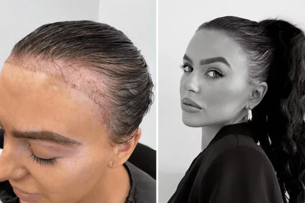 celebrity hair transplant before and after - rosie W