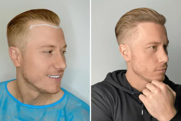 receding hairline before and after