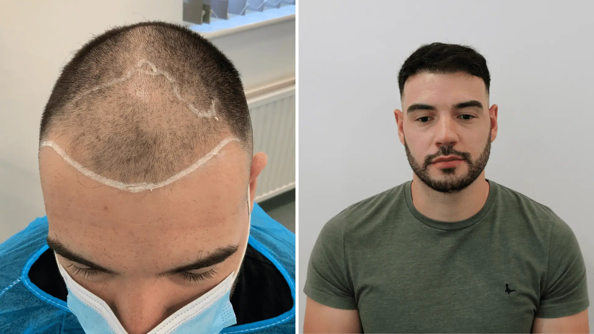 hair transplants in sheffield