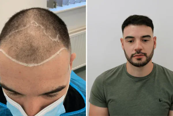 do hair loss treatments work?