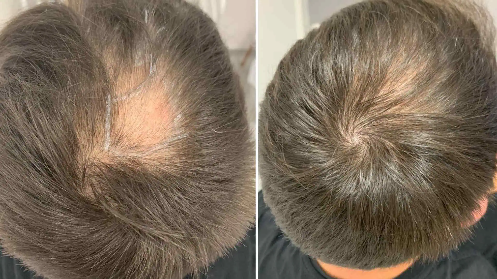 What Is the Role of a Hair Transplant in Scarring Alopecia?