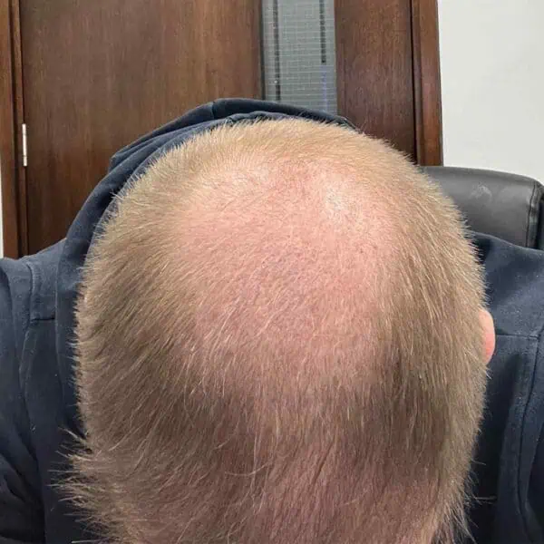 Can a Hair Transplant Help Diffuse Thinning?
