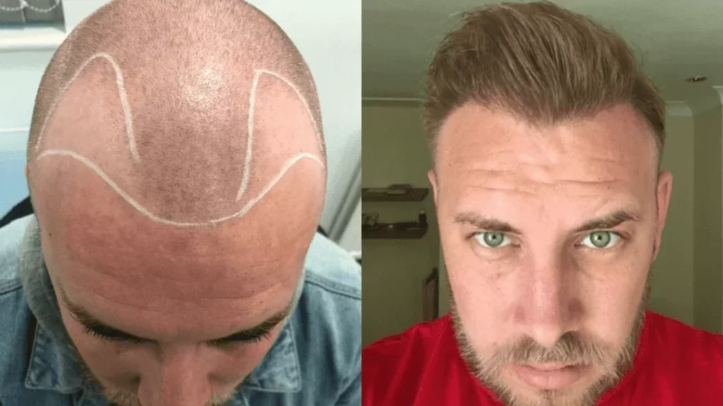 how to tell if your hairline is receding