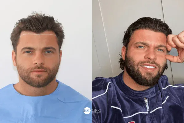 male hair transplant before and after