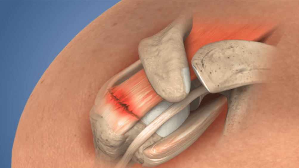 Rotator Cuff Surgery 101 Revere Health