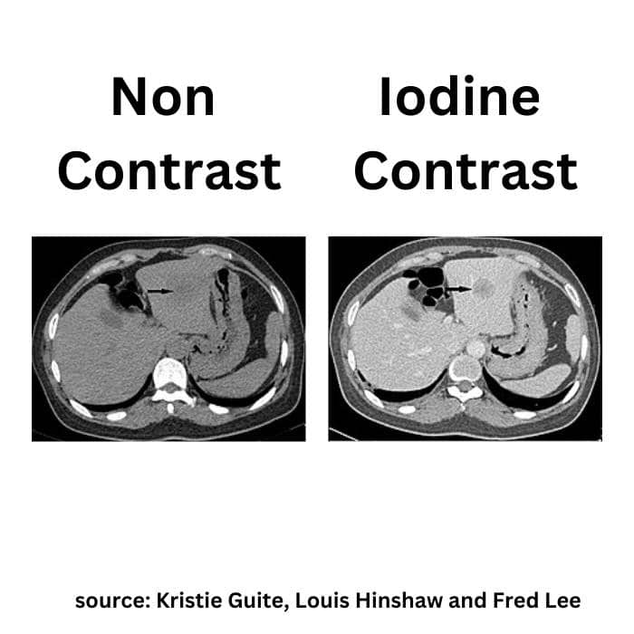 image with and without iodine