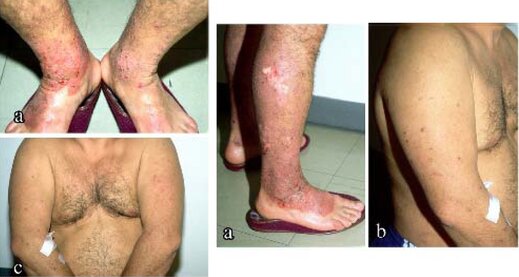 Knoten Auf Der Haut Ursachen Online Diagnose