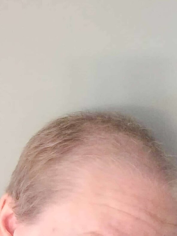 Hair Growth After Chemo Pictures And Monthly Timeline Mom S Plan It Vacation Blog