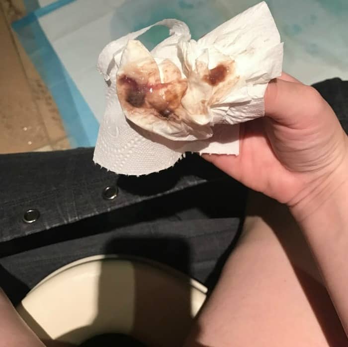 Mucus Plug 101: Who? What? Where? When? Why? (With Photos) Mucus Plug 101: Who? What? Where? When? Why? (With Photos)