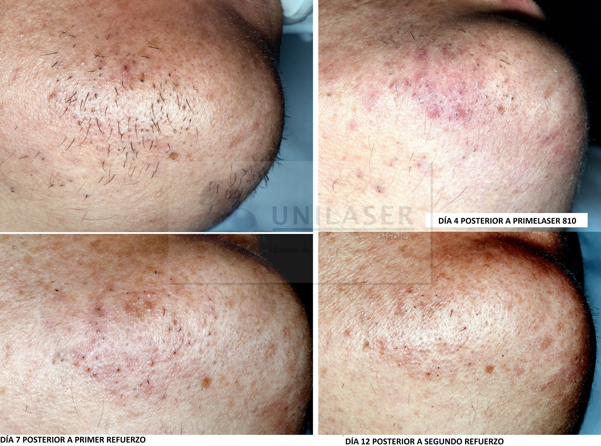 Cuantas Sesiones Se Necesitan Para Eliminar El Vello Con Laser