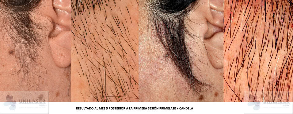 Láser Diodo Despues De La Primera Sesion De Laser Piel Laser Diodo