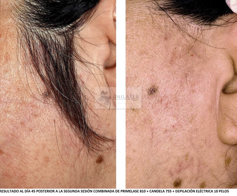 Laser Candela Resultados Primera Sesion Laser De Depilacion
