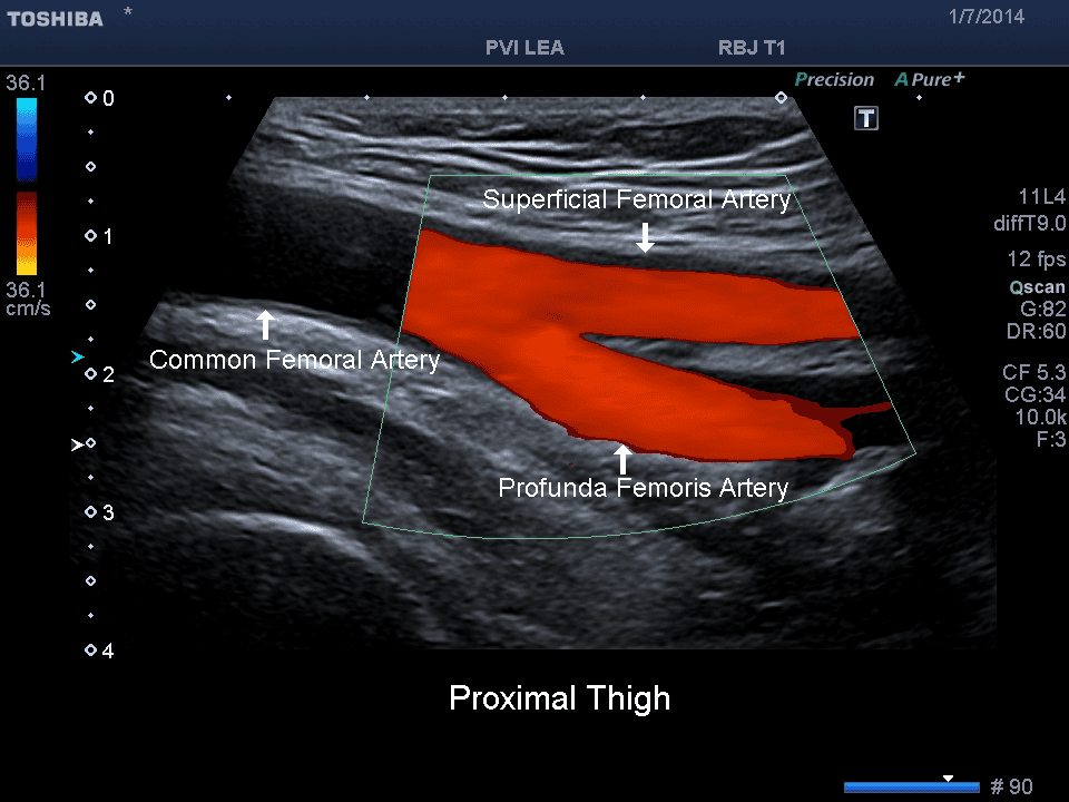 Peripheral Arterial Evaluations Pacific Vascular