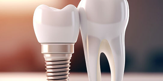 dental implants La Mesa dentist near me