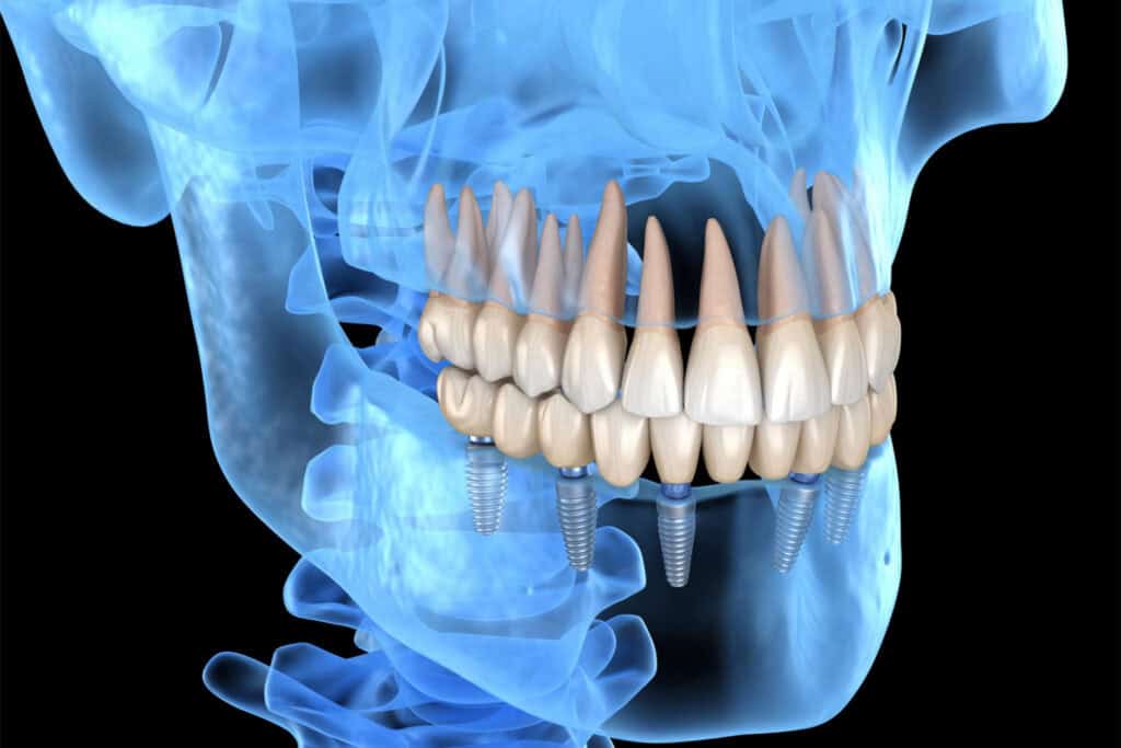 Dr. O’Sullivan Offers All-on-4 Implants and Full Mouth Reconstruction