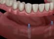 Overdentures-banner