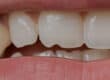 are-veneers-right-for-me-banner