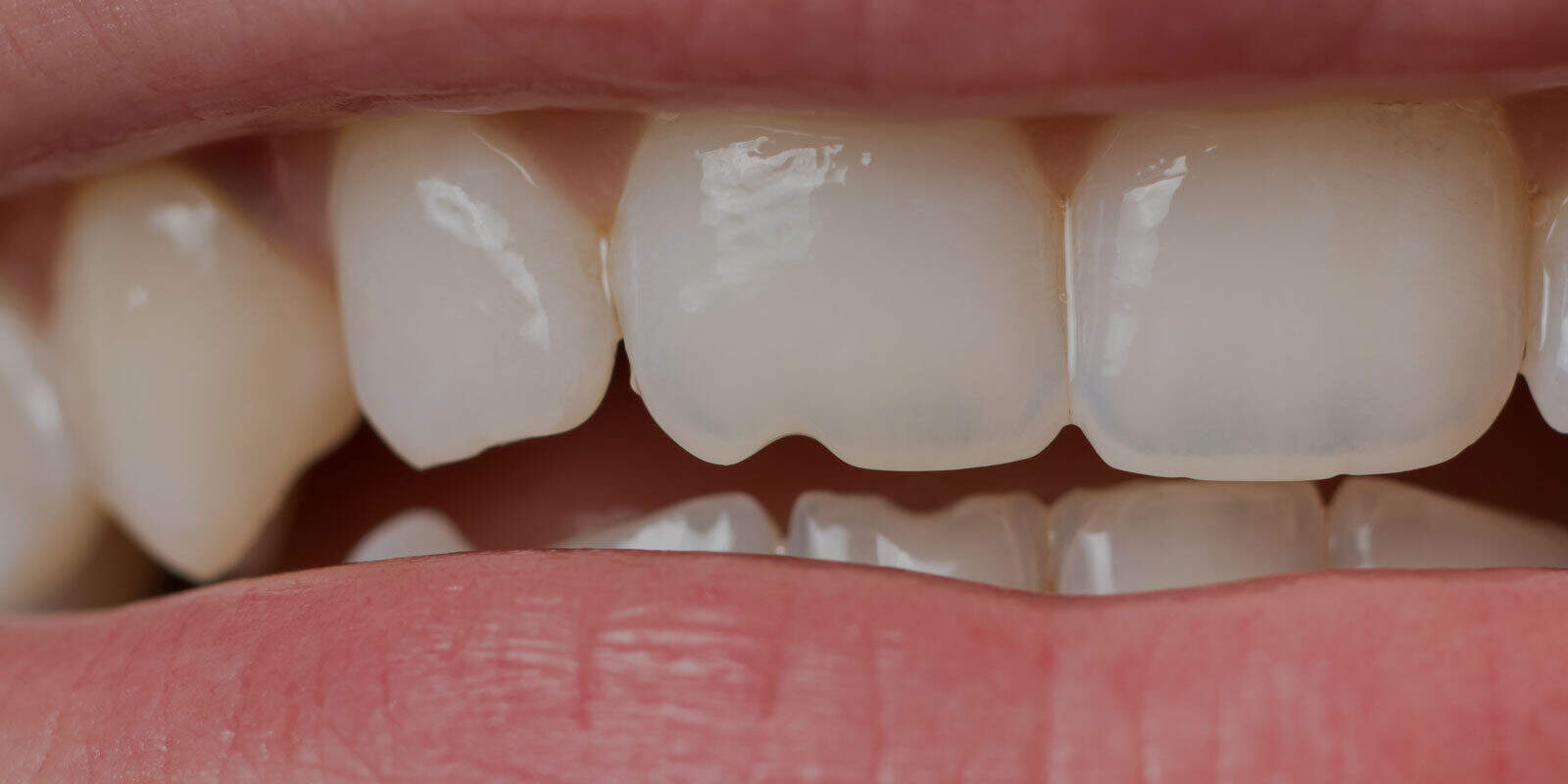 are-veneers-right-for-me-banner
