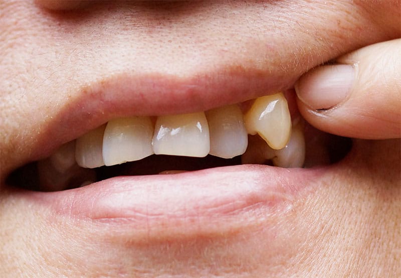 are-veneers-right-for-me-strip1