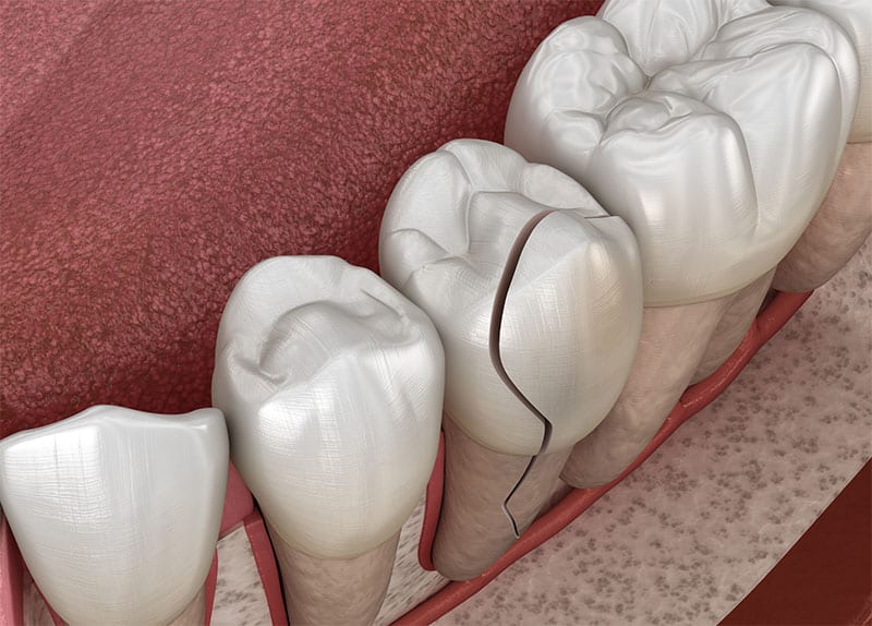 are-veneers-right-for-me-strip3