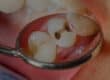 common-signs-of-tooth-decay-banner