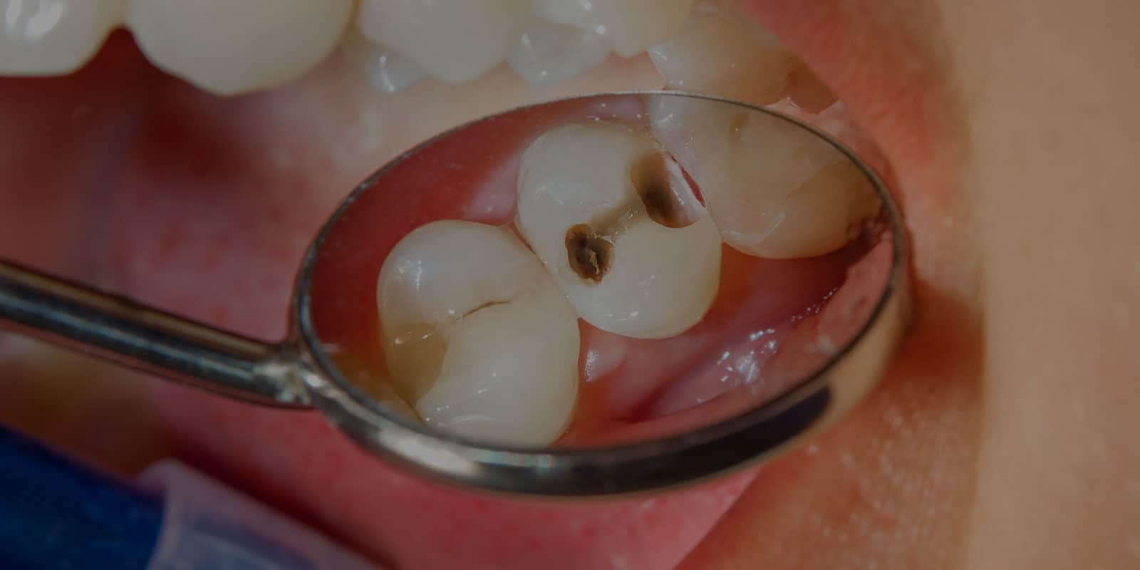 common-signs-of-tooth-decay-banner