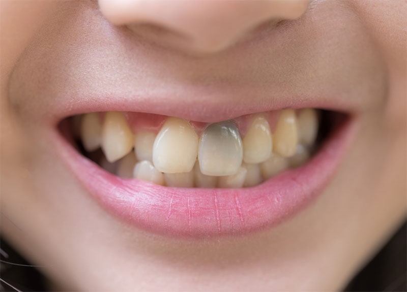 common-signs-of-tooth-decay-strip2