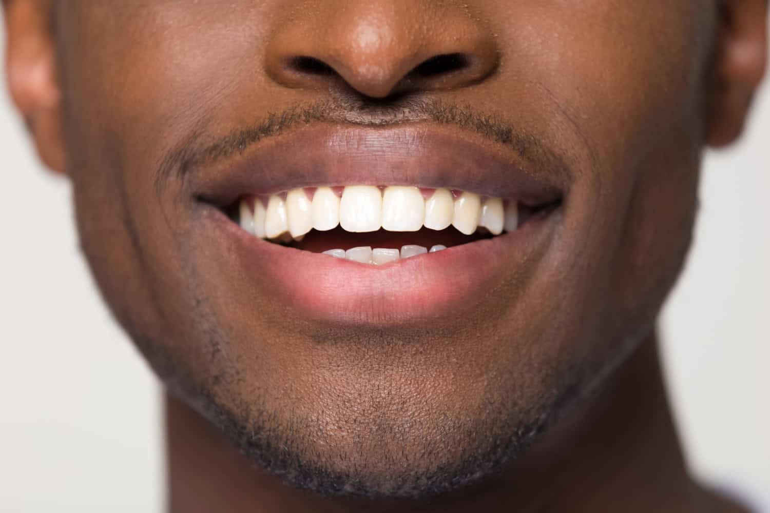 Full Mouth Reconstruction