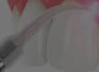 laser-gum-therapy_banner
