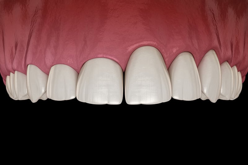 laser-gum-therapy_strip4