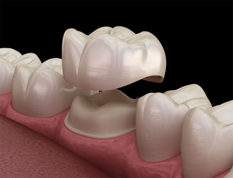 porcelain-crown-strip1