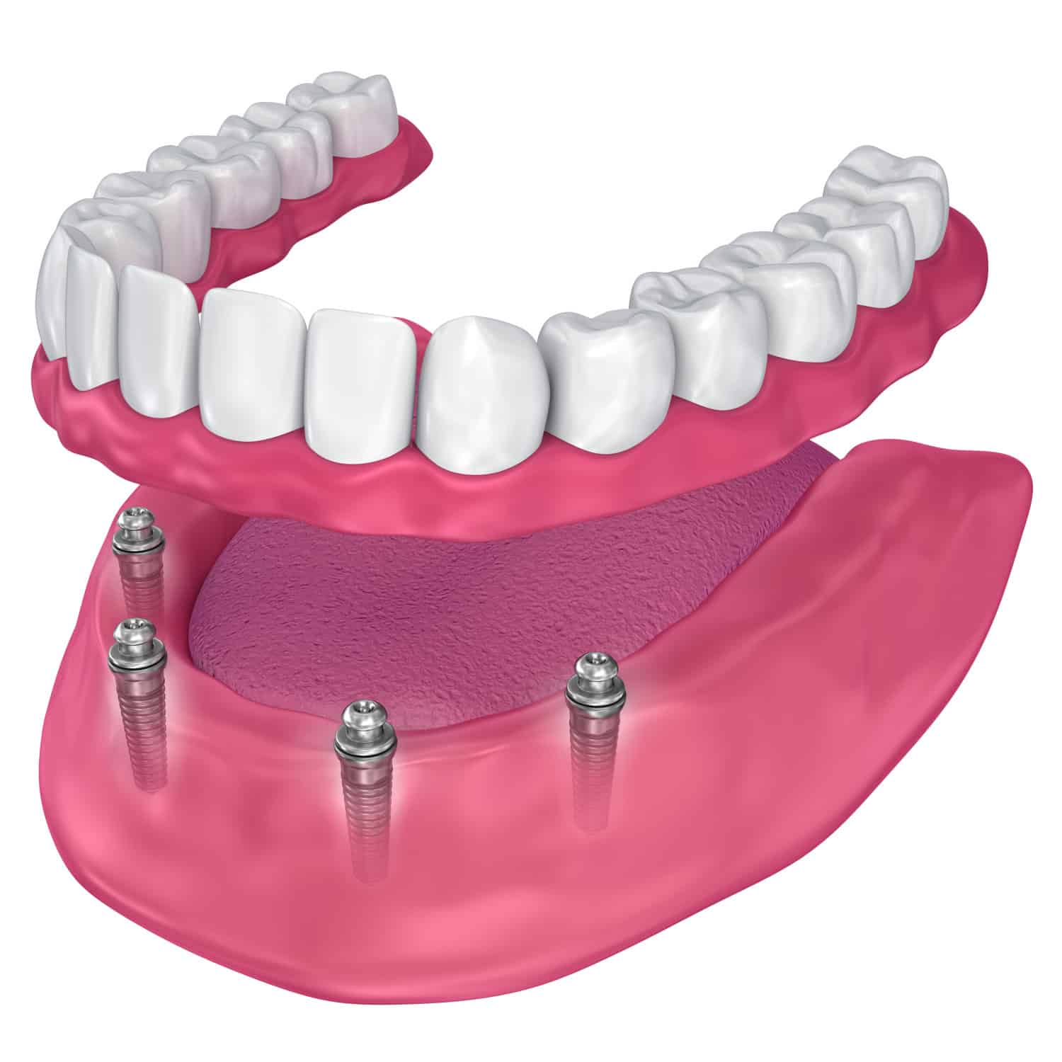 Snap-On Dentures
