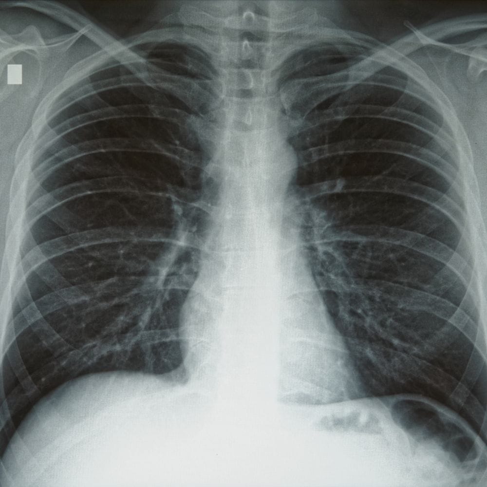 Hasil Rontgen Thorax Pa | Rontgen Thorax: Fungsi, Biaya, dan Prosedur ...