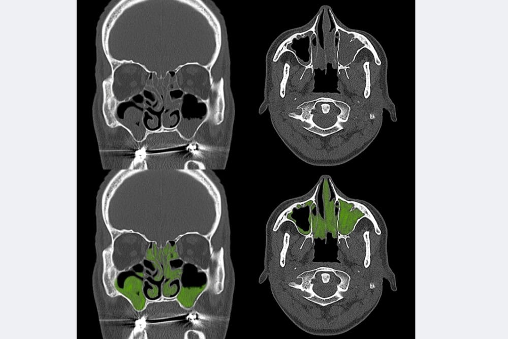 Wie Sieht Eine Sinusitis Im Ct Aus