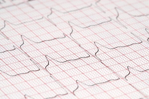Ekg Bilder Mit Erklärung