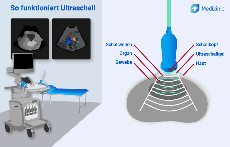 Schematische Darstellung der Ultraschalltechnik mit Schallkopf, Schallwellen und Gewebe sowie Ultraschallgerät im Hintergrund.