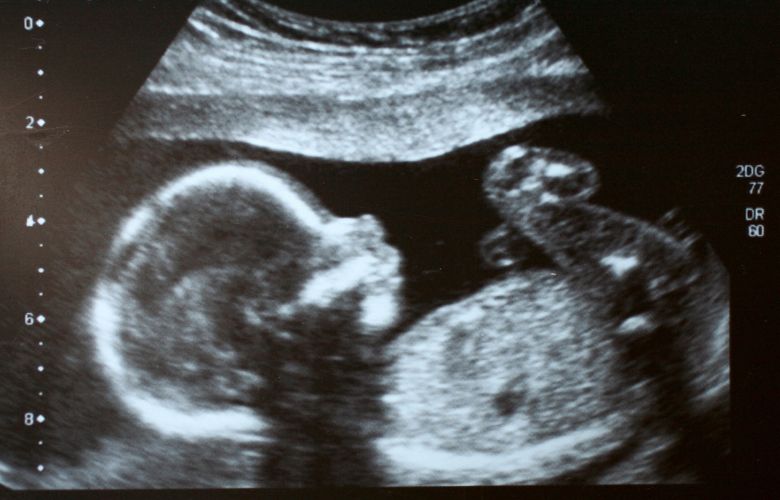 Ultraschallbild eines ungeborenen Babys, aufgenommen während einer Sonographie im Rahmen der pränatalen Vorsorge.