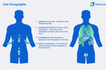 Schematische Darstellung der Fast-Sonographie mit markierten Untersuchungsbereichen zur Detektion freier Flüssigkeit im Körper.