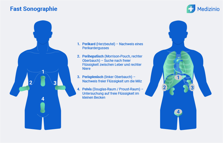 Schematische Darstellung der Fast-Sonographie mit markierten Untersuchungsbereichen zur Detektion freier Flüssigkeit im Körper.