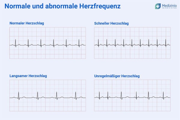 Ekg Bilder Mit Erklärung EKG (Elektrokardiogramm) einfach erklärt