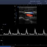 Doppler-Ultraschall der Arteria carotis mit Farbdoppler und Spektraldoppler auf dem SonoScape E2