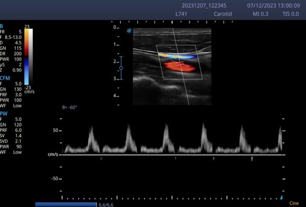 Doppler-Ultraschall der Arteria carotis mit Farbdoppler und Spektraldoppler auf dem SonoScape E2