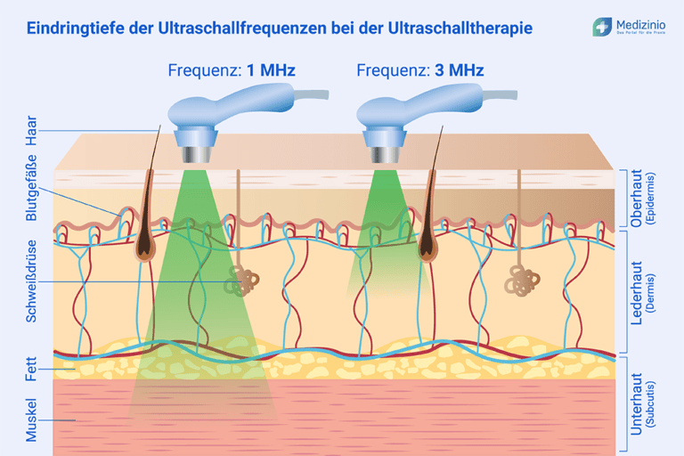alles-zur-ultraschalltherapie-in-der-physiotherapie
